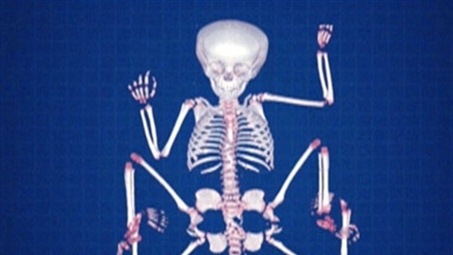 The Girl with Eight Limbs