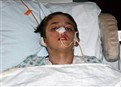 Burned Boy’s Mom: His ‘Courage Is Incredible’ picture