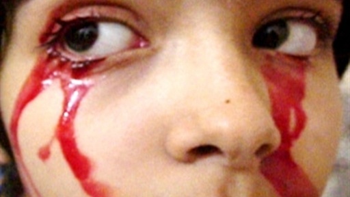 A Baffling Blood Disease Video