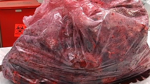 Anonymous Philanthropist Donates 200 Human Kidneys To Hospital