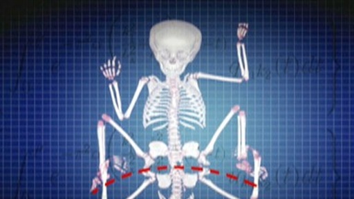 Risky Parasitic Twin Surgery