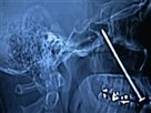 Man Makes Narrow Escape from Nail Gun